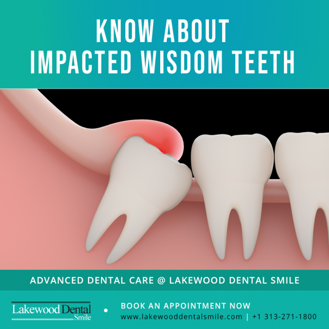 Know About Impacted Wisdom Teeth - Lakewood Dental Smile