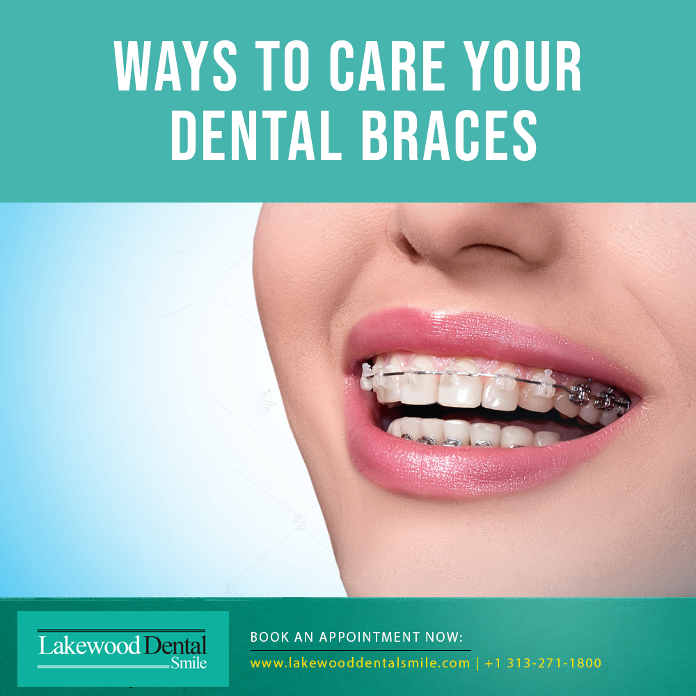Ways To Care Your Dental Braces - Lakewood Dental Smile